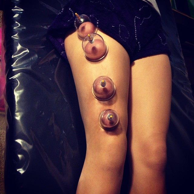 Cupping for Knee Pain